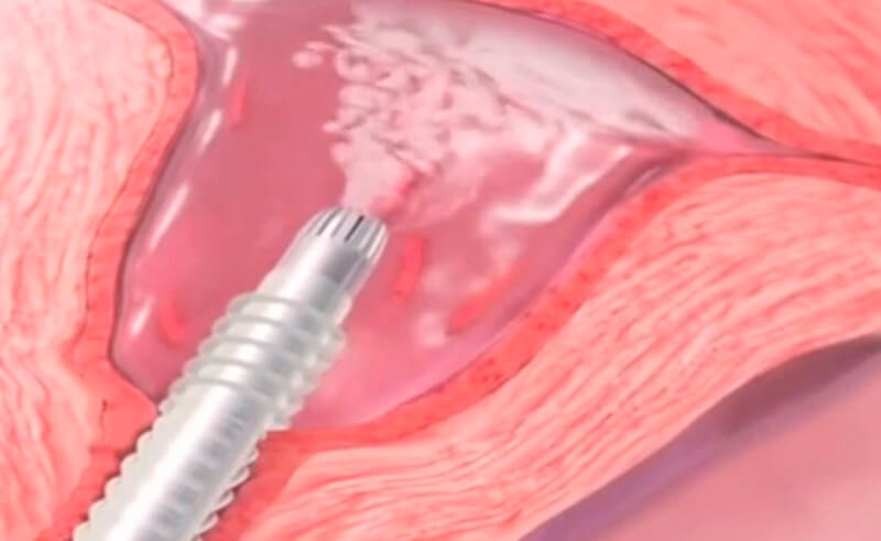 Littleton's Holistic Endometrial Ablation Procedure
