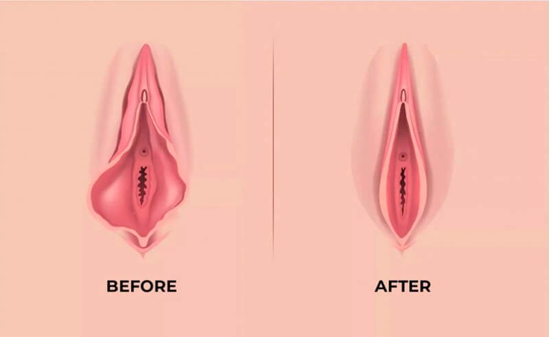 gyne-urog-labiaplasty1