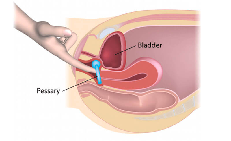 gyne-urog-pessary3